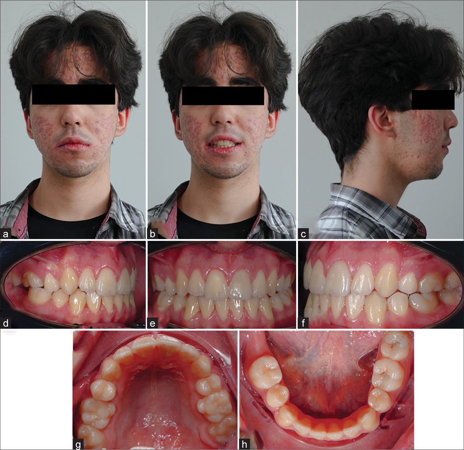 Intraoral and extraoral photographs of patient 2 post-treatment. (a) Frontal extraoral photograph. (b) Smiling extraoral photograph. (c) Lateral extraoral photograph. (d) Right intraoral photograph. (e) Frontal intraoral photograph. (f) Left intraoral photograph. (g) Occlusal view of maxillary arch. (h) Occlusal view of mandibular arch.