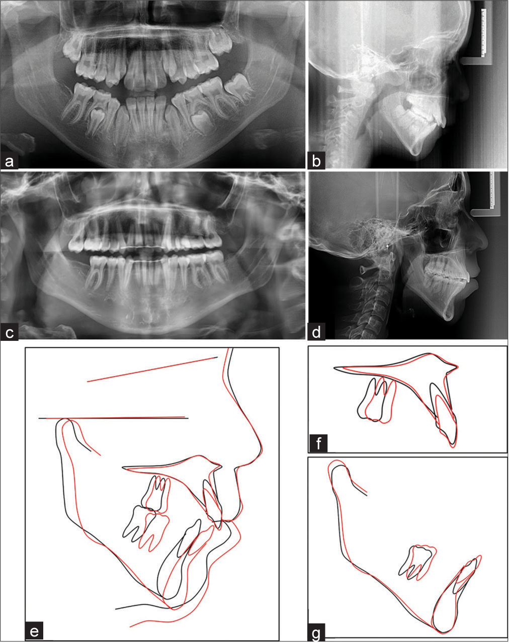 Radiographs and superimpositions of patient 1 pre- and post-treatment. (a) Pre-treatment panoramic radiograph. (b) Pre-treatment lateral cephalometry. (c) Post-treatment panoramic radiograph. (d) Post-treatment lateral cephalometry. (e) Superimposition of pre-treatment (black) and post-treatment (red) cephalometric tracings was registered on sella nasion (SN) line at sella. (f) The maxillary superimposition of pre-treatment (black) and post-treatment (red) was registered on the palatal plane at anterior nasal spine (ANS). (g) The mandibular superimposition of pre-treatment (black) and post-treatment (red) was registered on the lingual aspect of the symphysis.