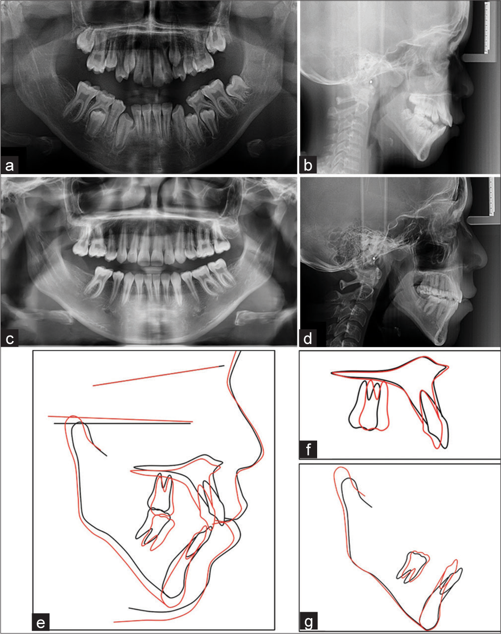 Radiographs and superimpositions of patient 2 preand post-treatment. (a) Pre-treatment panoramic radiograph. (b) Pre-treatment lateral cephalometry. (c) Post-treatment panoramic radiograph. (d) Post-treatment lateral cephalometry. (e) Superimposition of pre-treatment (black) and post-treatment (red) cephalometric tracings was registered on sella nasion (SN) line at sella. (f) The maxillary superimposition of pre-treatment (black) and post-treatment (red) was registered on the palatal plane at anterior nasal spine ANS. (g) The mandibular superimposition of pre-treatment (black) and post-treatment (red) was registered on the lingual aspect of the symphysis.