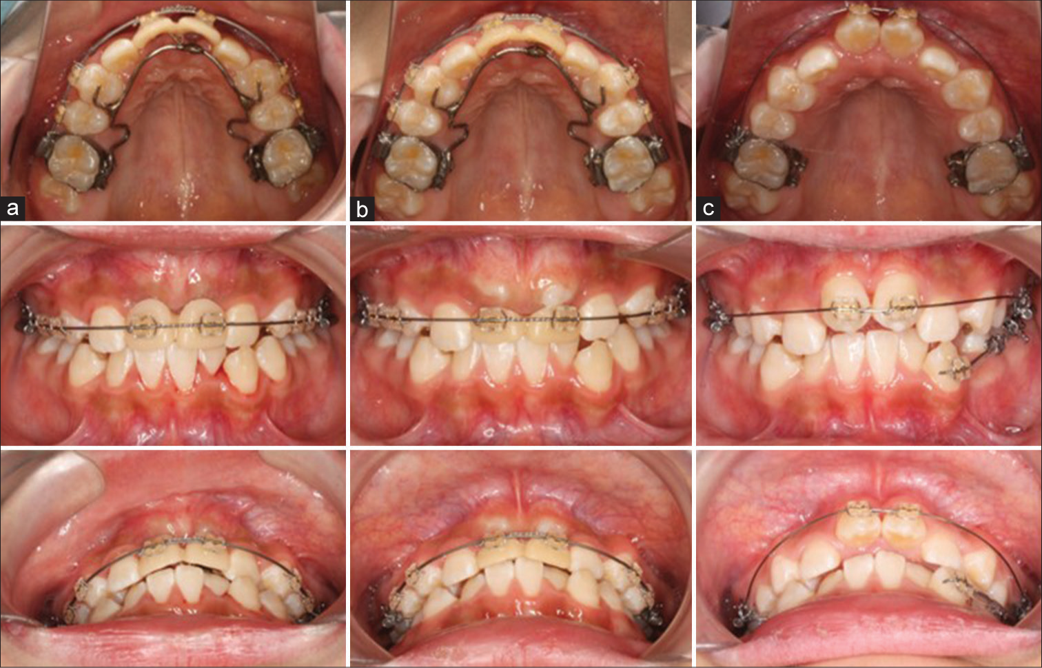 Treatment progress. (a) Traction of the impacted canines. (b) After 5 months of traction. The contour of the canines can be observed. (c) After 12 months of traction. Beginning of the mandibular alignment.