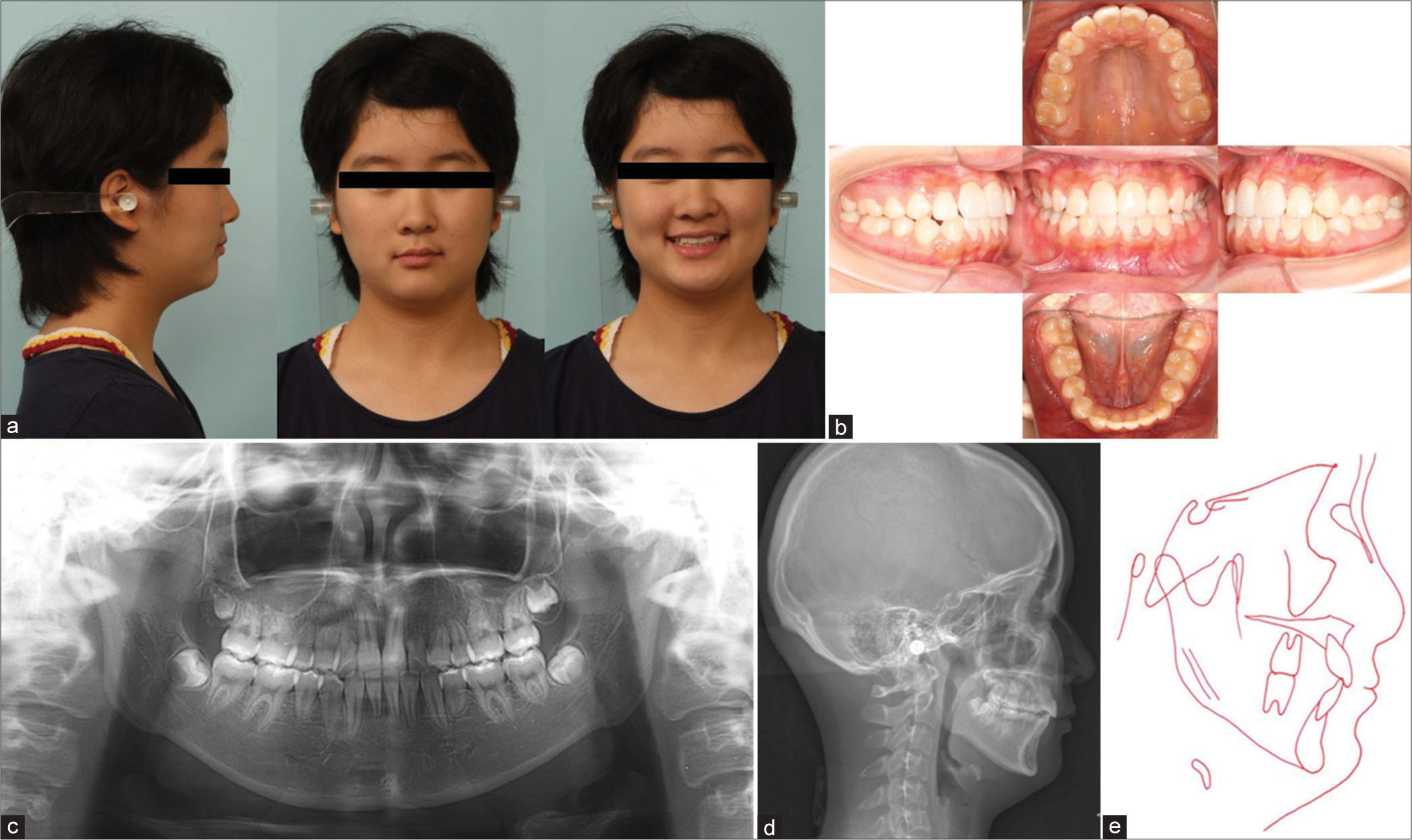 Post-treatment. After 31 months of the active treatment: (a) Post-treatment facial photographs. (b) Post-treatment intraoral photographs. (c) Post-treatment panoramic radiographs. (d) Post-treatment cephalometric radiographs, (e) Post-treatment cephalometric tracing.