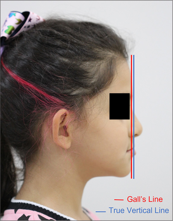 Image showing the true vertical line and Gall’s line in a patient with mandibular protrusion and maxillary retrusion.