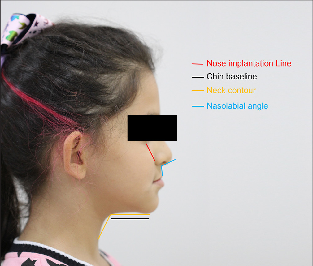 Image showing nose implantation line, chin baseline, neck contour, and nasolabial angle in a patient with mandibular protrusion and maxillary retrusion.