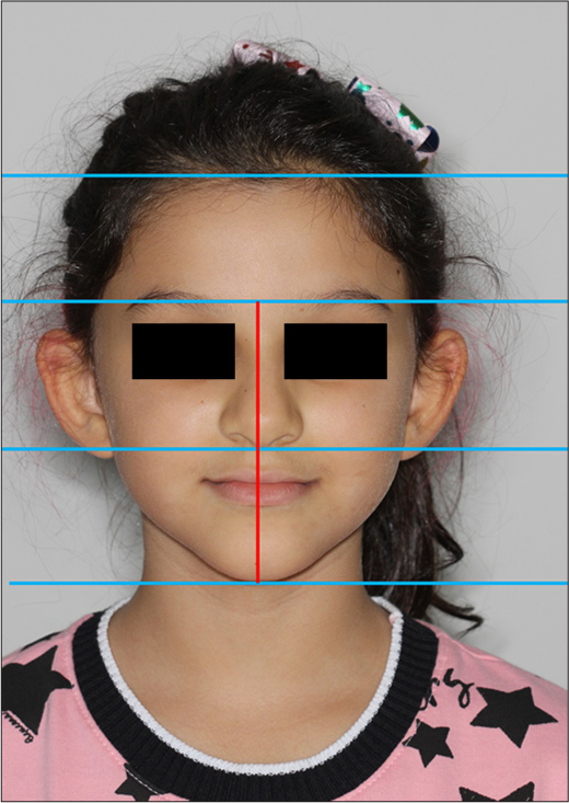 Frontal image; the horizontal lines (blue lines) are drawn to evaluate the facial thirds and the vertical line (red line) to analyze facial asymmetry.