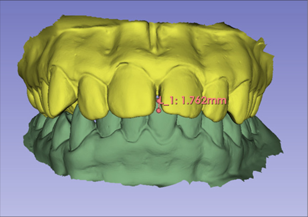 Linear measurements for transverse evaluation TVS (transverse, vertical, and sagittal) analysis. (a) Intermolar and intercanine distances in the upper arch. (b) Most buccal bone portion in the region of upper molars and canines. (c) Intermolar and intercanine distances in the lower arch. (d) Most buccal bone portion in the region of lower molars and canines.