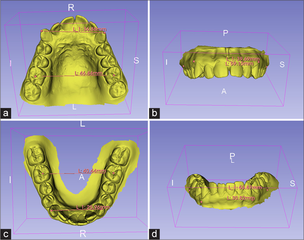 Linear measurements for vertical evaluation or overbite TVS (transverse, vertical, and sagittal) analysis.