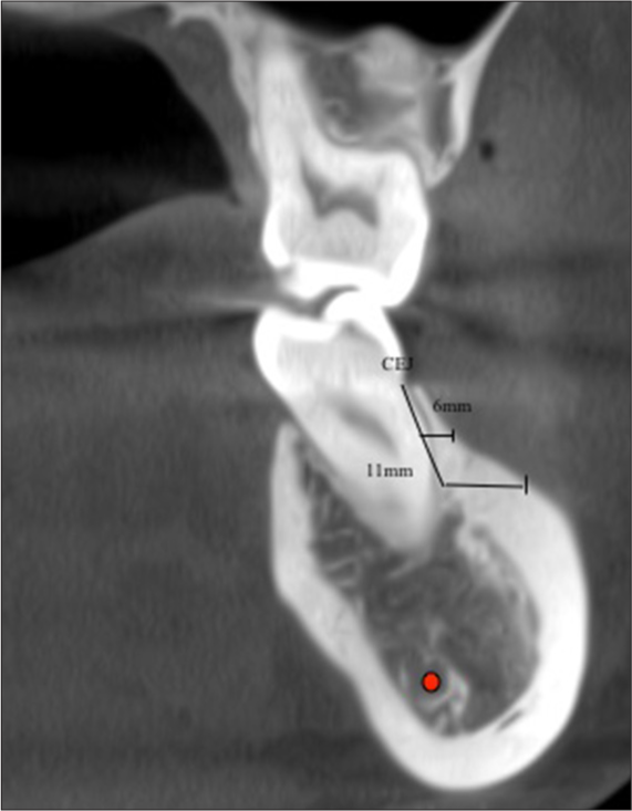 Assessment of bone thickness at 6 mm and 11 mm from cementoenamel junction (CEJ). Red dot denotes Inferior alveolar nerve canal (IANC)