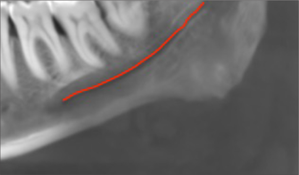 Tracing of inferior alveolar nerve canal. Red line indicates Inferior alveolar nerve canal