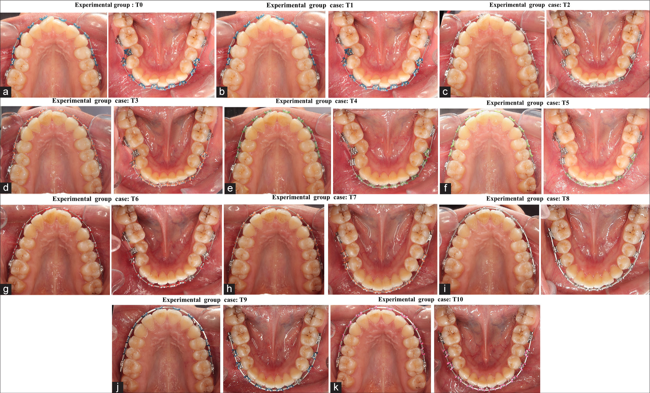 (a-k) Progressive intra-oral photographs for an experimental group patient at each measurement point.