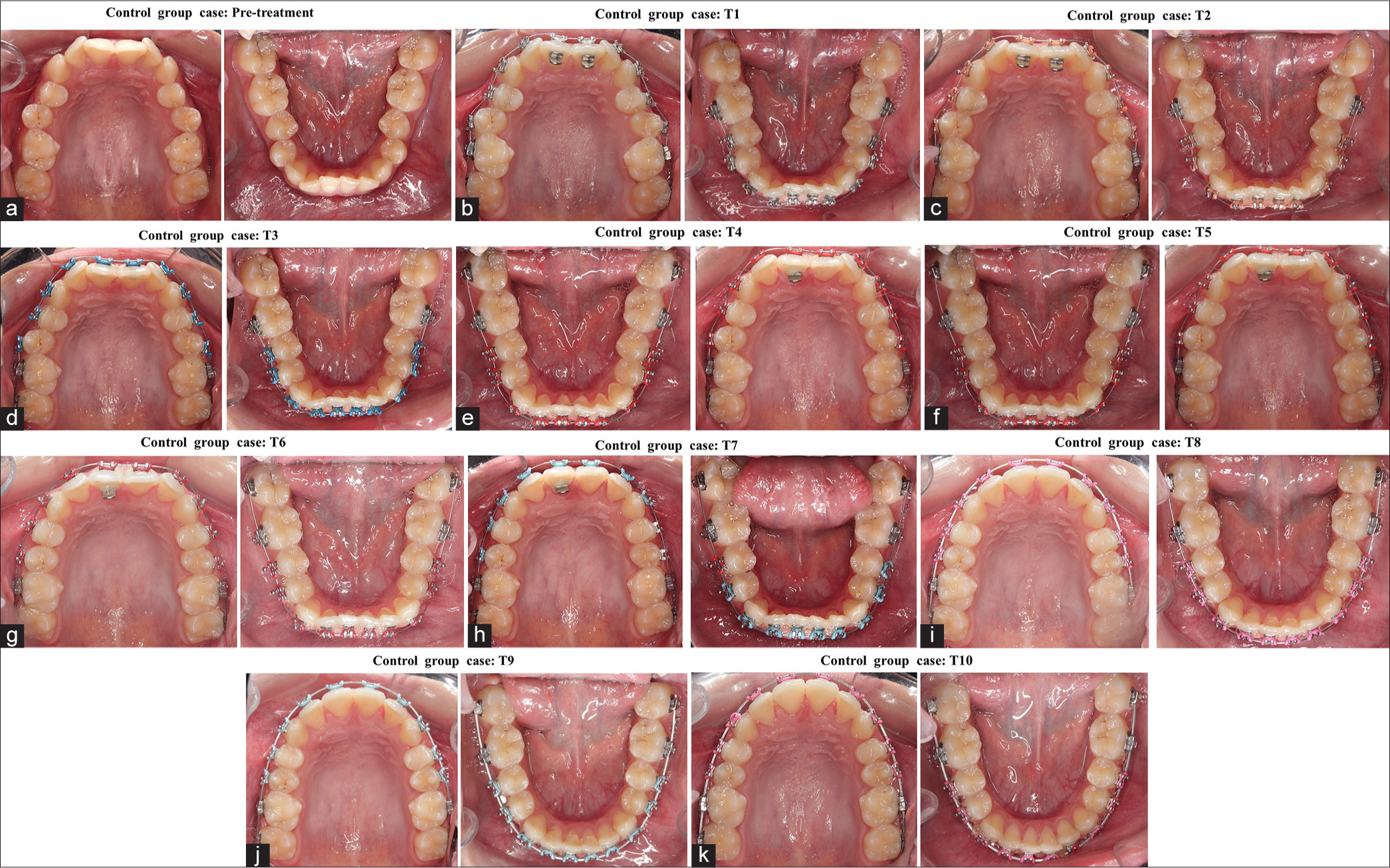 (a-k) Progressive intra-oral photographs for a control group patient at each measurement point.