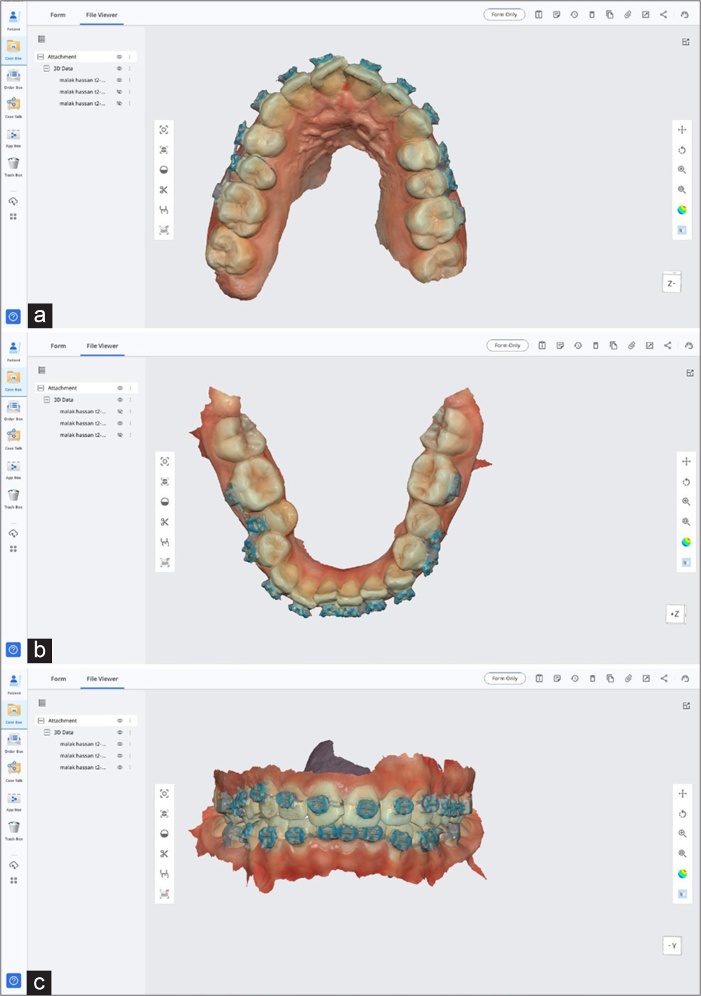 (a-c) Digital dental model for upper and lower teeth fabricated on IOS software.