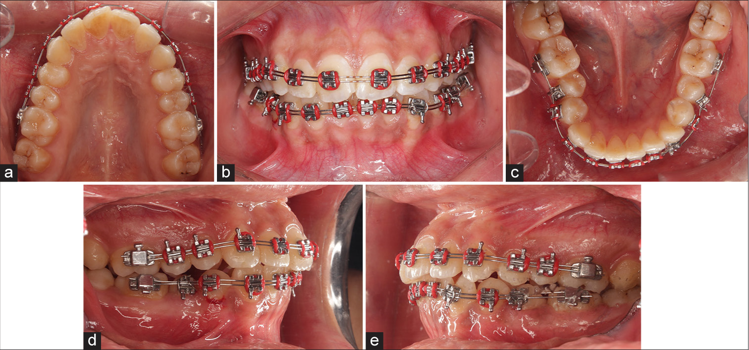 (a-e) Progressive intra-oral photographs for an experimental group patient.