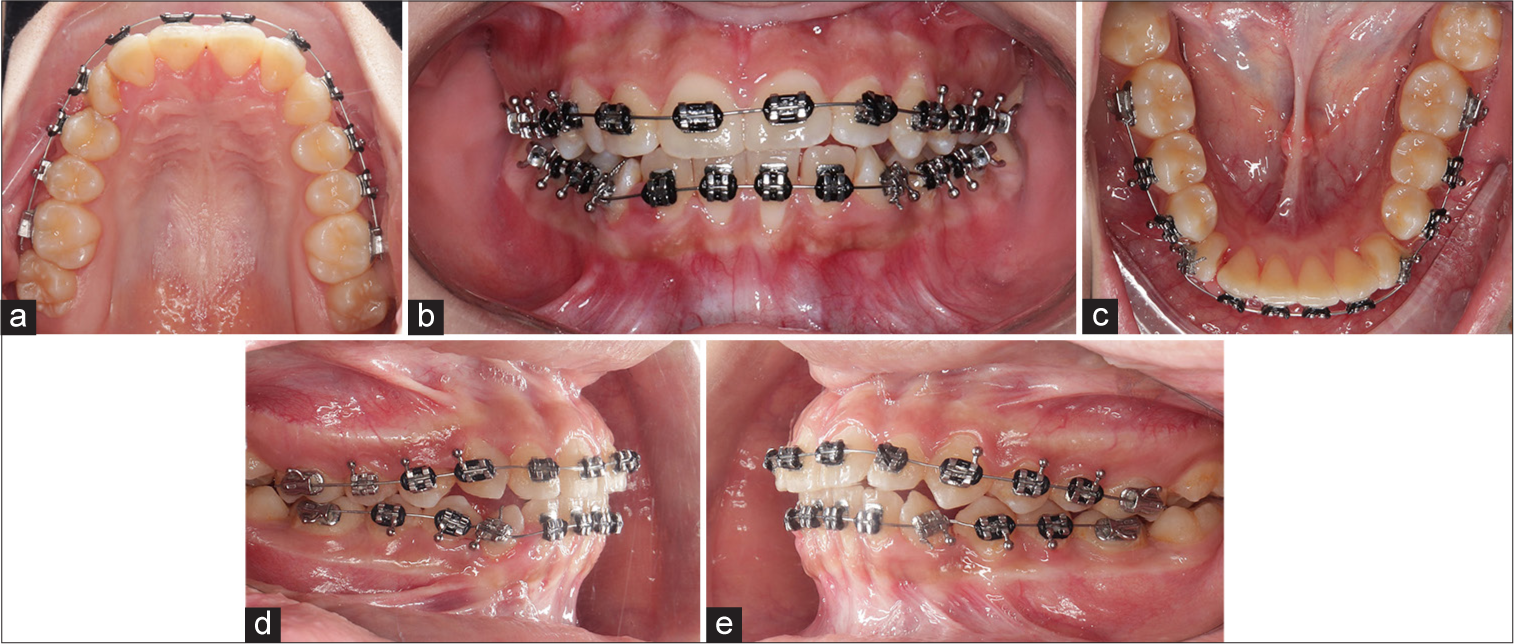 (a-e) Progressive intra-oral photographs for a control group patient.