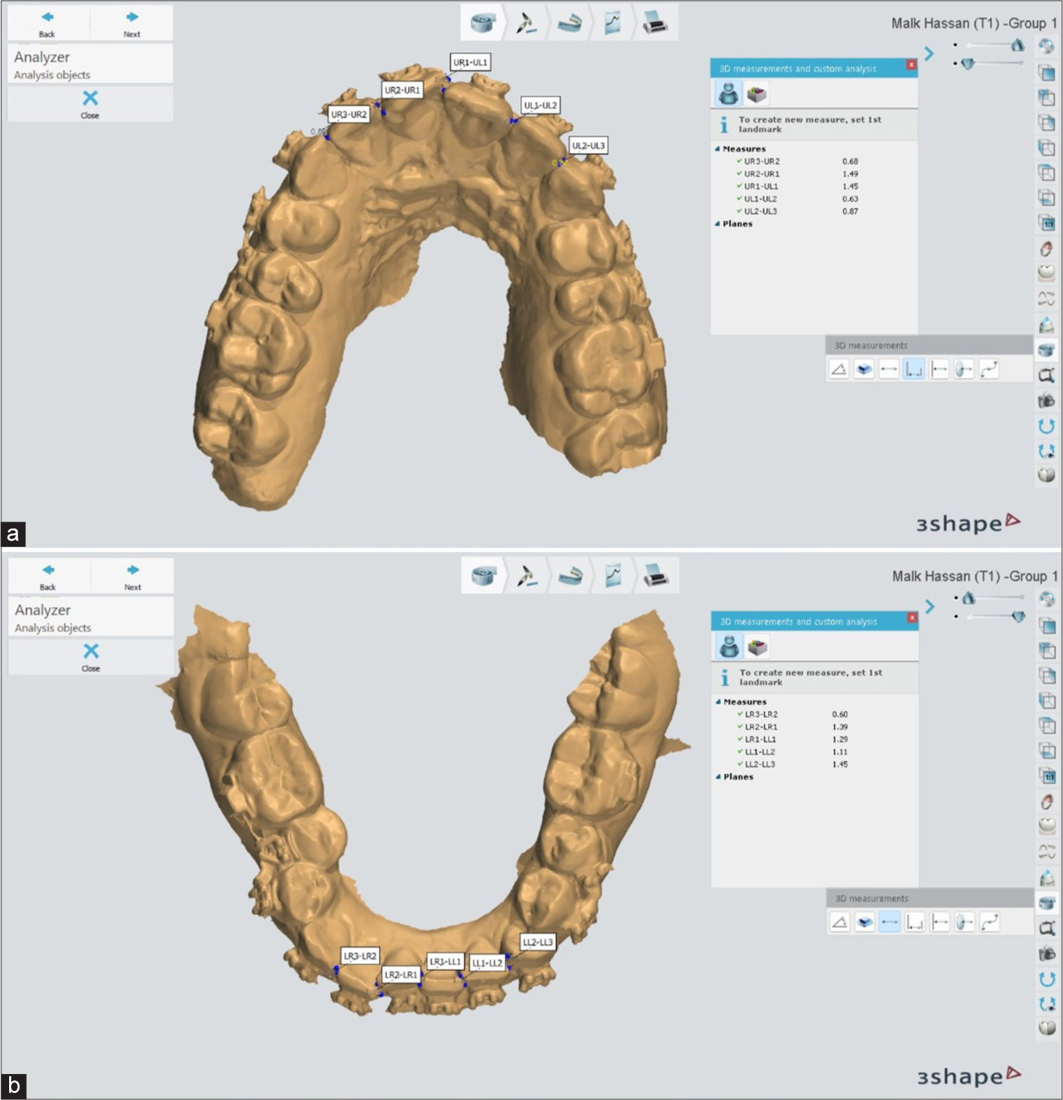 (a and b) Digital calliper tool has been used to measure Little’s index of irregularity on a digital model using 3Shape Ortho System software.