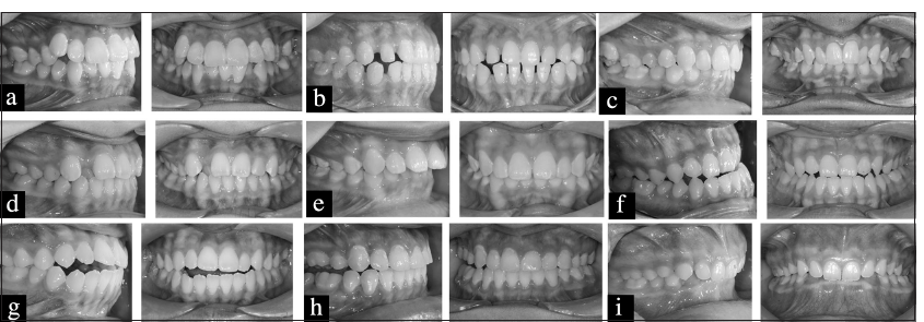 Example of oral photographs with buccal and frontal views representing malocclusion traits of (a) crowding, (b) spacing, (c) posterior crossbite, (d) anterior crossbite, (e) increased overjet, (f) reverse overjet, (g) anterior open bite, (h) lateral open bite, and (i) deep overbite.