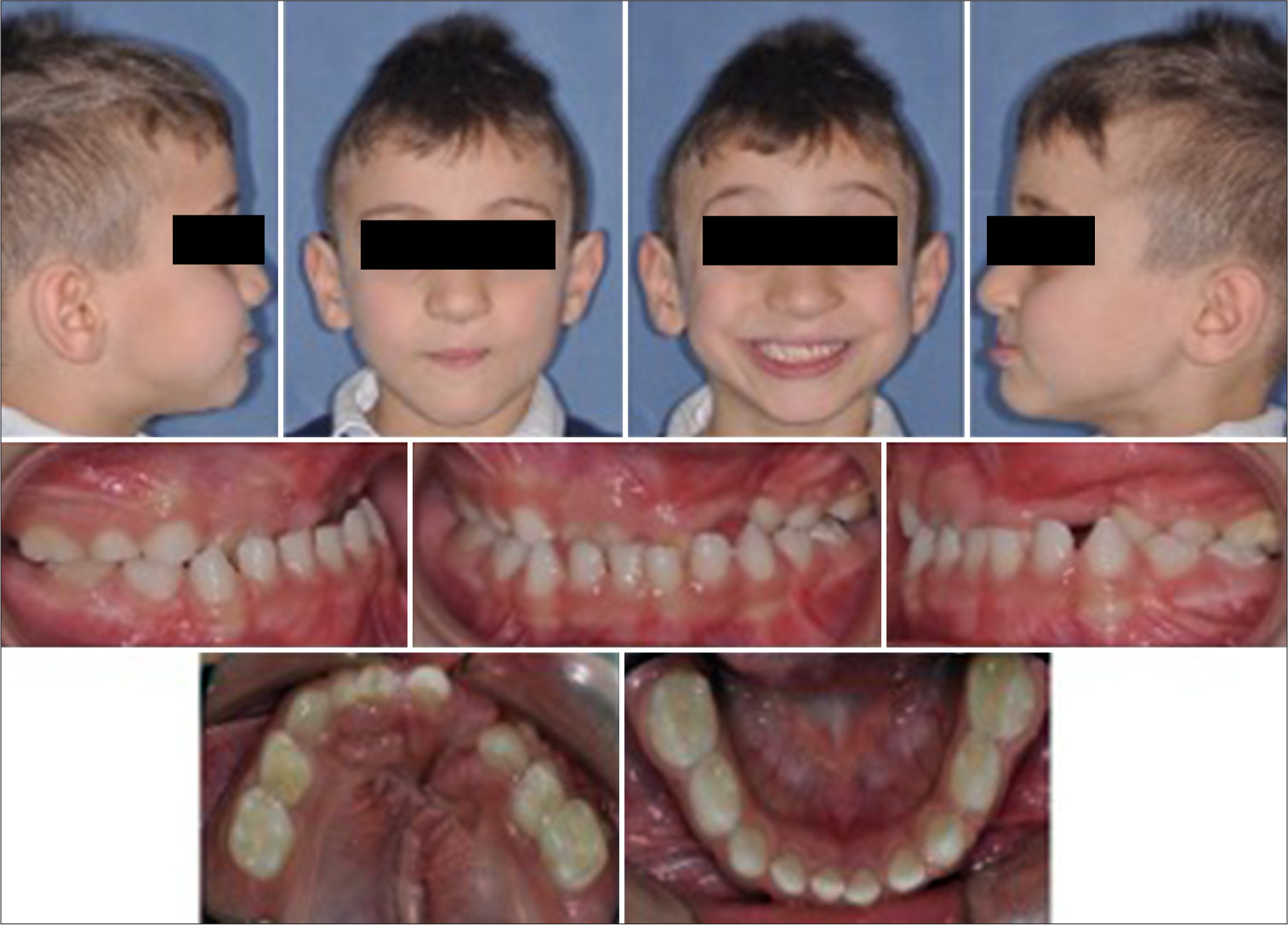 Initial intraoral photographs of a patient in mixed dentition with unilateral cleft lip and palate (T0).