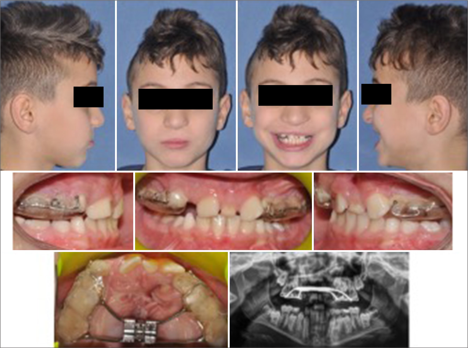 Intraoral photographs and panoramic X-ray after treatment (T1).