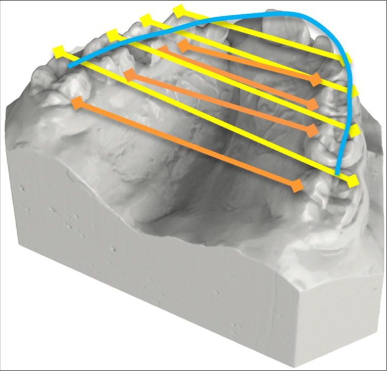 Digital dental casts of the upper arch with transverse diameters and arch length (yellow: occlusal plane, orange: gingival plane, blue: arch lenght at occlusal plane).