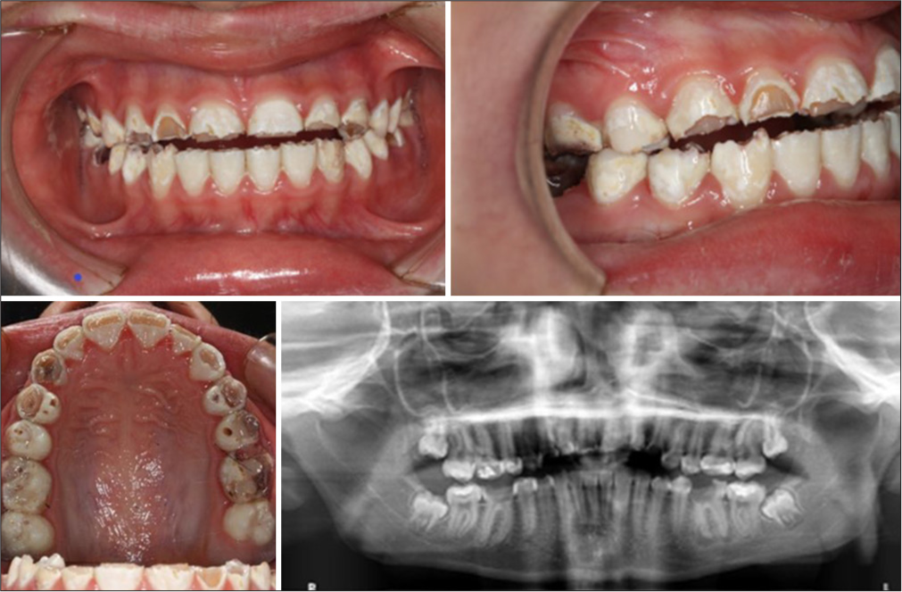 Intraoral views and panoramic radiography depicting extensive enamel destruction.