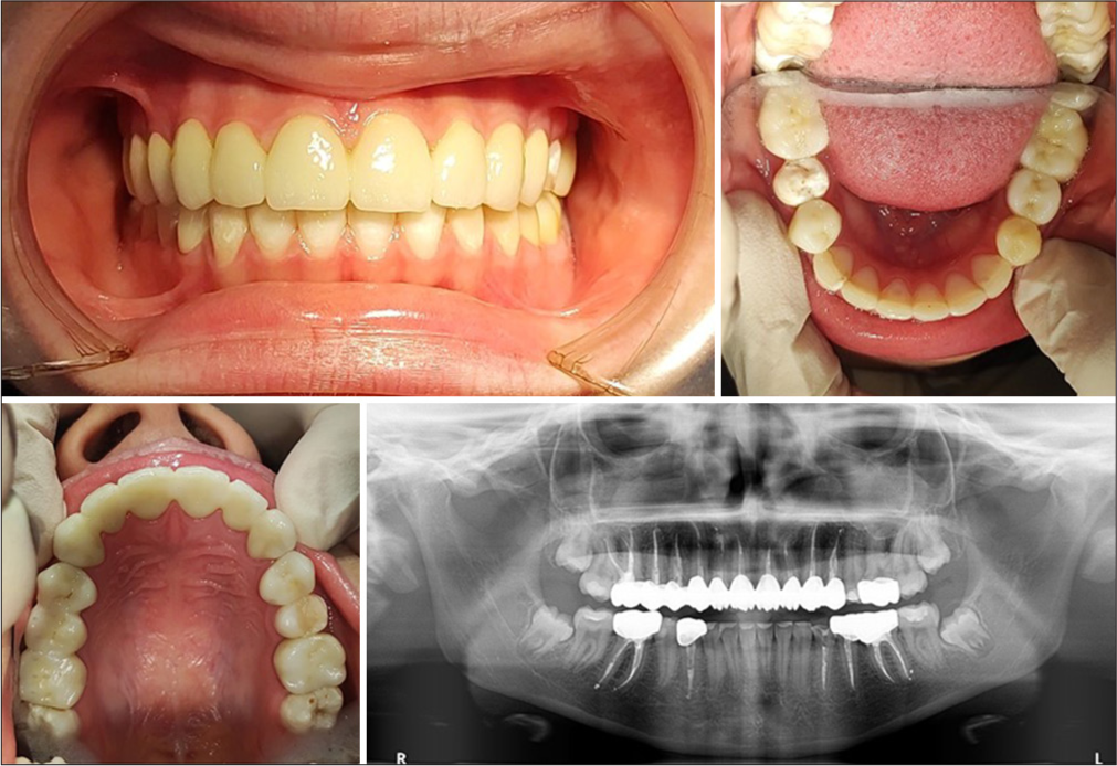 Intraoral views and panoramic radiography after complete reconstruction with restorative dentistry.