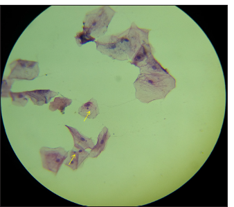 Micronuclei stained with papanicolaou (PAP) highlighted in high-power magnified field.