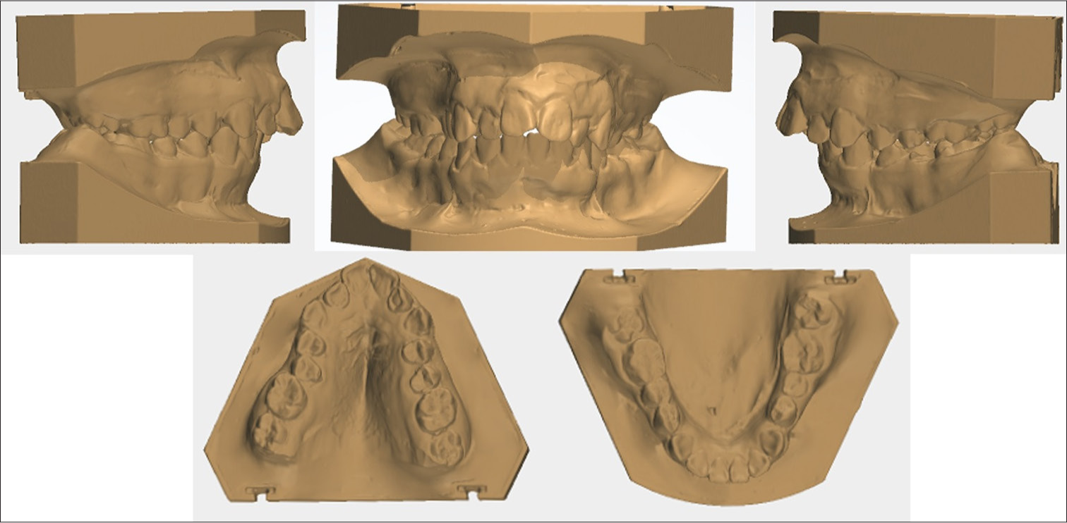 Pre-treatment study models.
