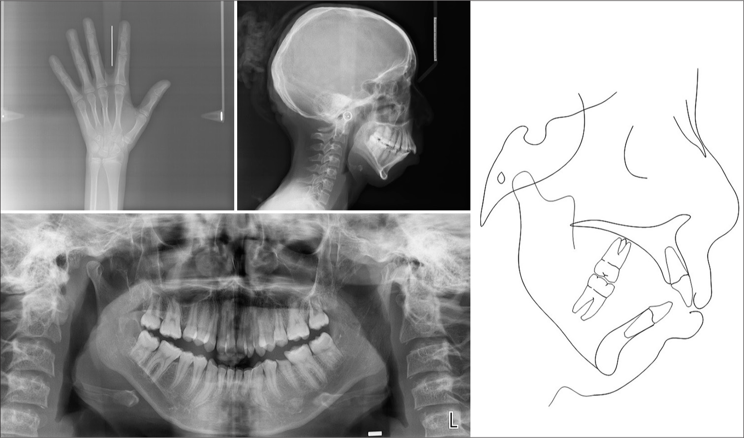 (a) Pre-treatment hand-wrist radiograph; (b) pre-treatment lateral cephalogram; (c) pre-treatment panoramic radiograph; (d) pre-treatment cephalometric tracing