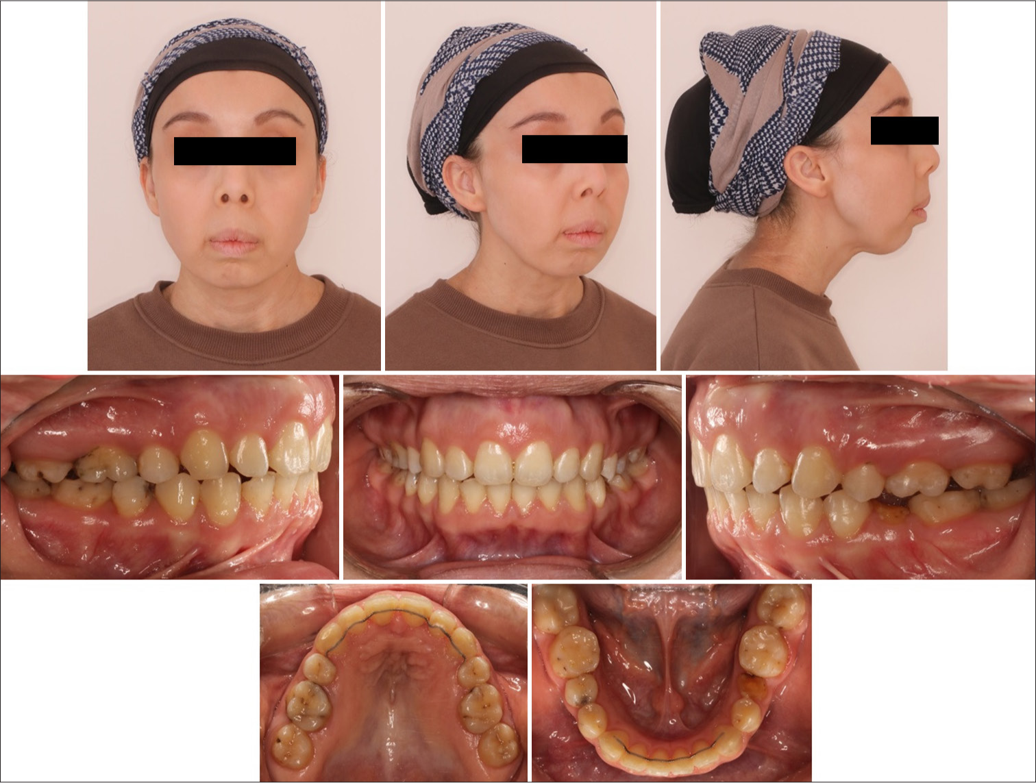 (a) post-treatment extraoral photographs; (b) post-treatment intraoral photographs.