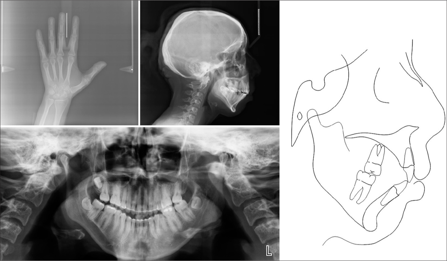 (a) Post-treatment hand-wrist radiograph; (b) post-treatment lateral cephalogram; (c) post-treatment panoramic radiograph; (d) post-treatment cephalometric tracing.