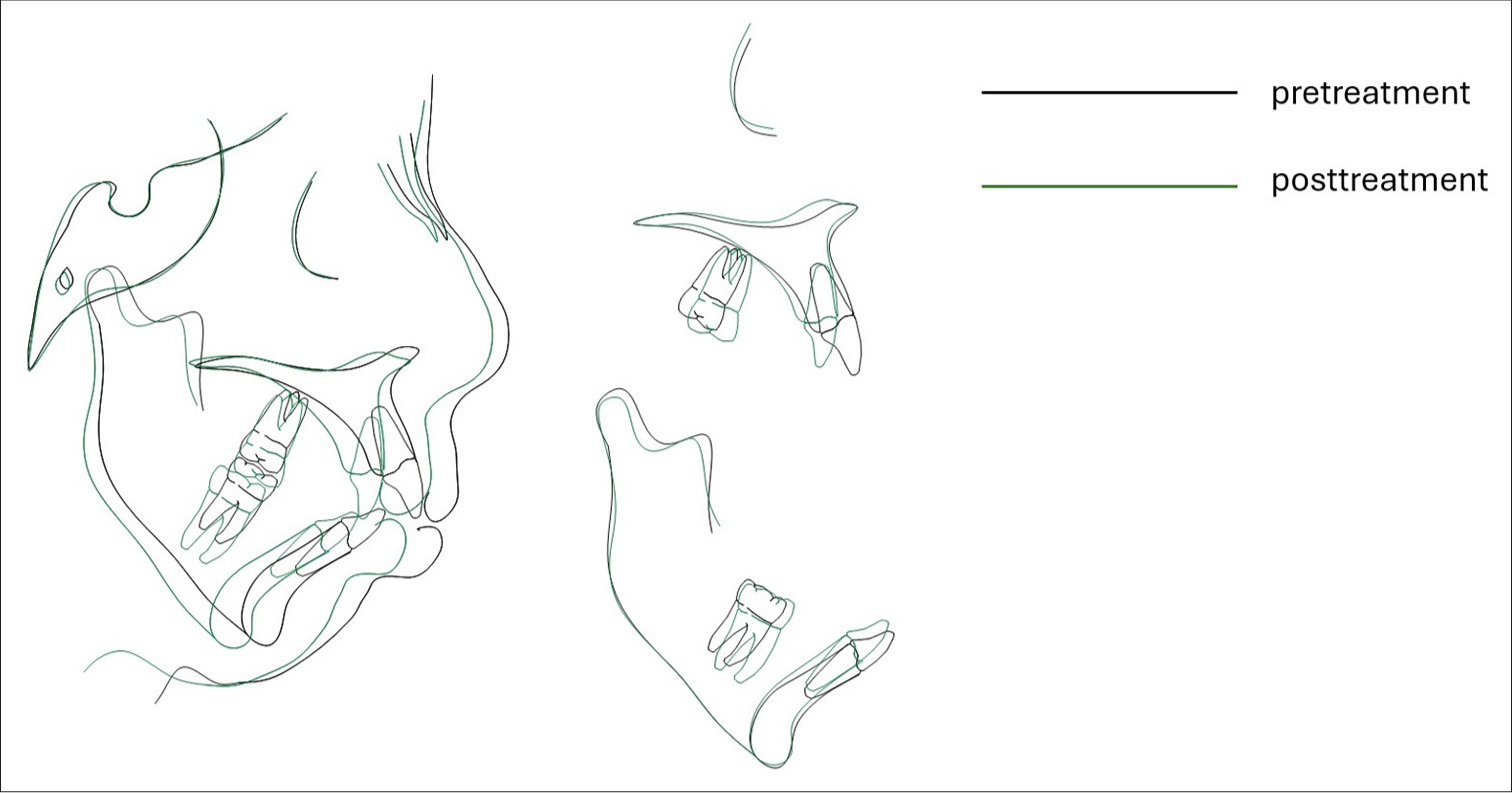 Cephalometric superimposition showed significant maxillary incisor retrusion. It also resulted in clockwise rotation of the mandible.