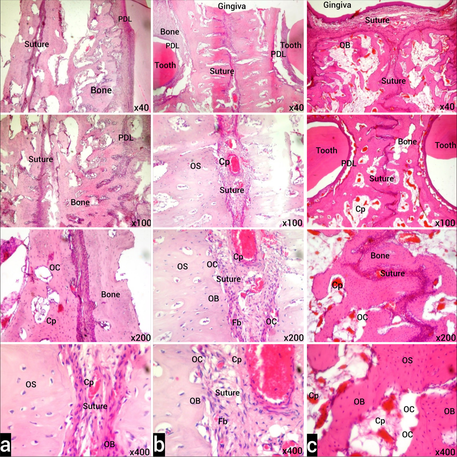 (a) Images of H&E stained sections from the T2 period of the control group under light microscope. Normal histological appearance is observed in the examination of the tooth and its surrounding PDL, alveolar bone, and suture. (b) H&E-stained sections of tissue samples belonging to Group I in the T2 period under light microscope. Although less than Group II, compared to the control group, increased blood capillaries (Cp) in the examination of the tooth and surrounding PDL, alveolar bone and expanded suture, active fibroblasts (Fb), osteoclasts in the endosteum (OC), and active osteoblasts (OB) are observed. (c) Light microscope images of H&E-stained sections of tissue samples belonging to Group II in the T2 period. In the examination of the tooth and its surrounding PDL, alveolar bone and enlarged suture, increased blood Cp, active Fb, numerous OC, and active OB in the endosteum are observed. Osteoclast (OC), Osteoblast (OB), Osteocyte (OS), Capillary (Cp), Fibroblast (Fb) Stain: H&E (X40, X100, X200, X400 original magnifications). PDL: Periodontal ligament, H&E: Hematoxylin-Eosin.