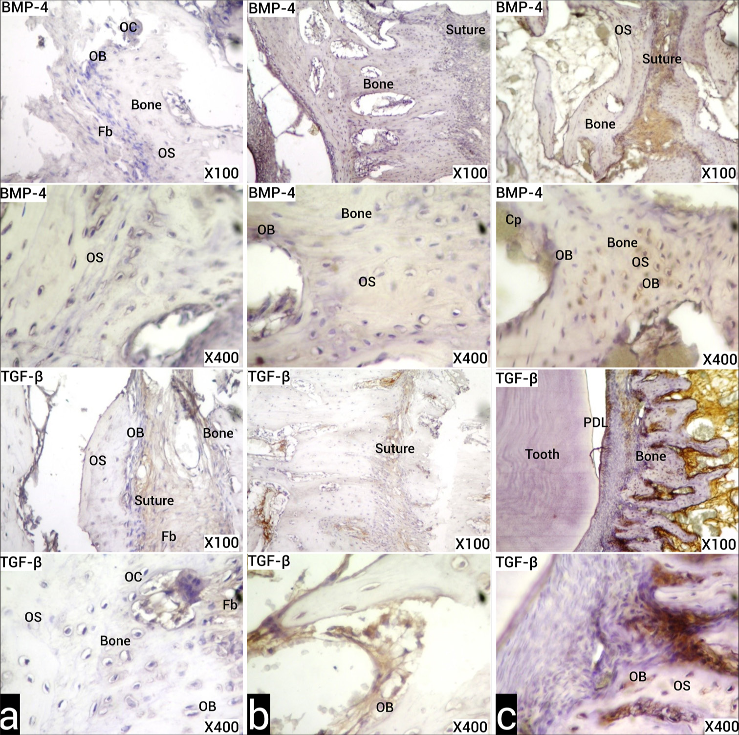 (a) Images of the sections obtained from the experimental animals of the control group in the T2 period, stained with the indirect immunohistochemistry method with anti-BMP-4 and anti-TGF-β primary antibodies, under light microscope. Positive immunoreactivities are seen as stained brown. (b) Images of the samples obtained in the T2 period from experimental animals belonging to Group I, under the light microscope, stained with the indirect IHC method with anti-BMP-4 and anti-TGF-β primary antibodies. Brown positive and increased immunoreactivity is observed in suture-forming fibroblasts, osteoblasts, and osteocytes. (c) Images of the samples obtained in the T2 period from experimental animals belonging to Group II, sections stained with the indirect IHC method with anti-BMP-4 and anti-TGF-β primary antibodies under light microscope. More BMP-4 and TGF-β immunoreactivity is observed in suture-forming fibroblasts, osteoblasts, and osteocytes than Group I. Osteoclast (OC), Osteoblast (OB), Osteocyte (OS), Capillary (Cp), Fibroblast (Fb). (X100, X400 original magnifications). BMP-4: Bone morphogenetic protein-4, TGF-β: Transforming growth factor-beta.