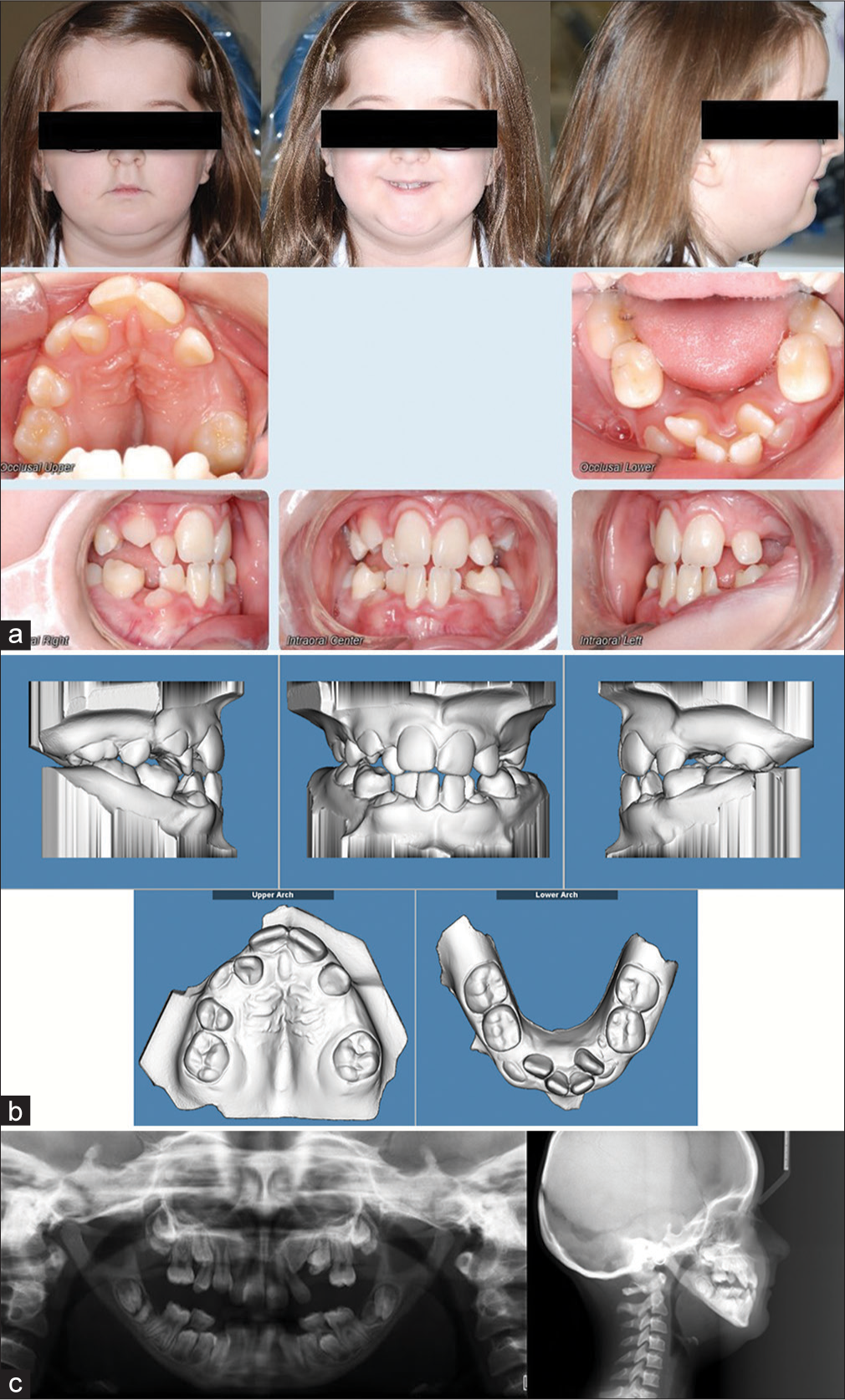 (a) Phase I pre-treatment extraoral and intraoral photographs. (b) Phase I pre-treatment models. (c) Phase I pre-treatment panoramic radiograph, lateral cephalogram.