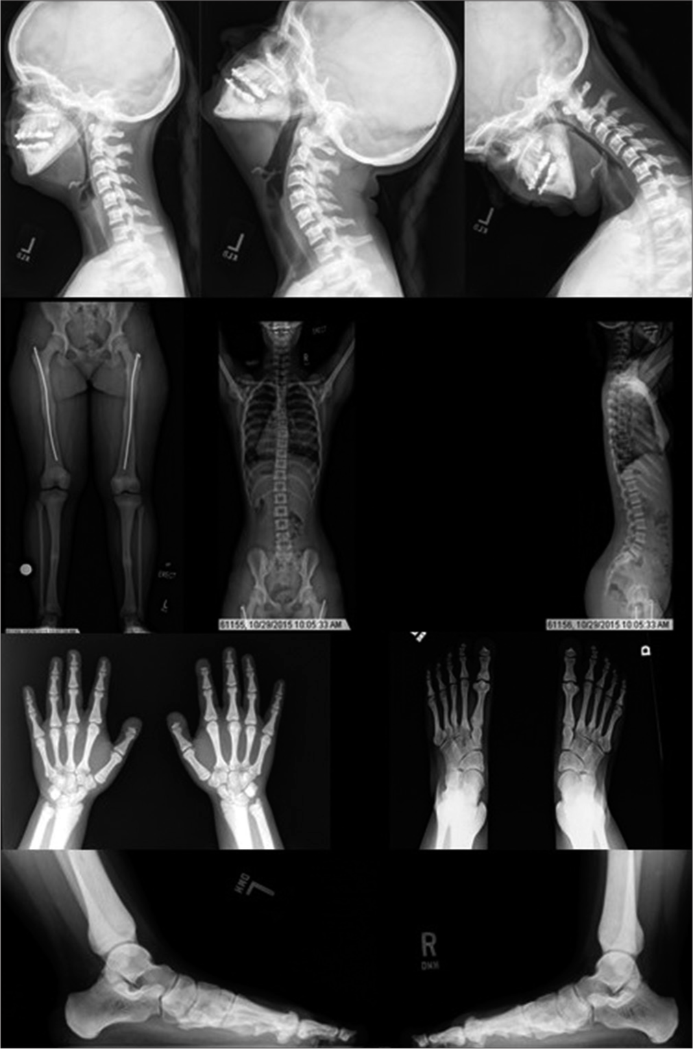 Systemic radiographs for diagnosis of pycnodysostosis.