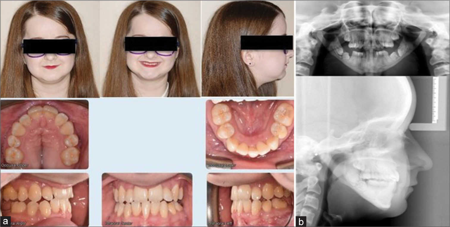 (a) Phase I post-treatment extraoral and intraoral photographs. (b) Phase I post-treatment panoramic radiograph and lateral cephalogram.