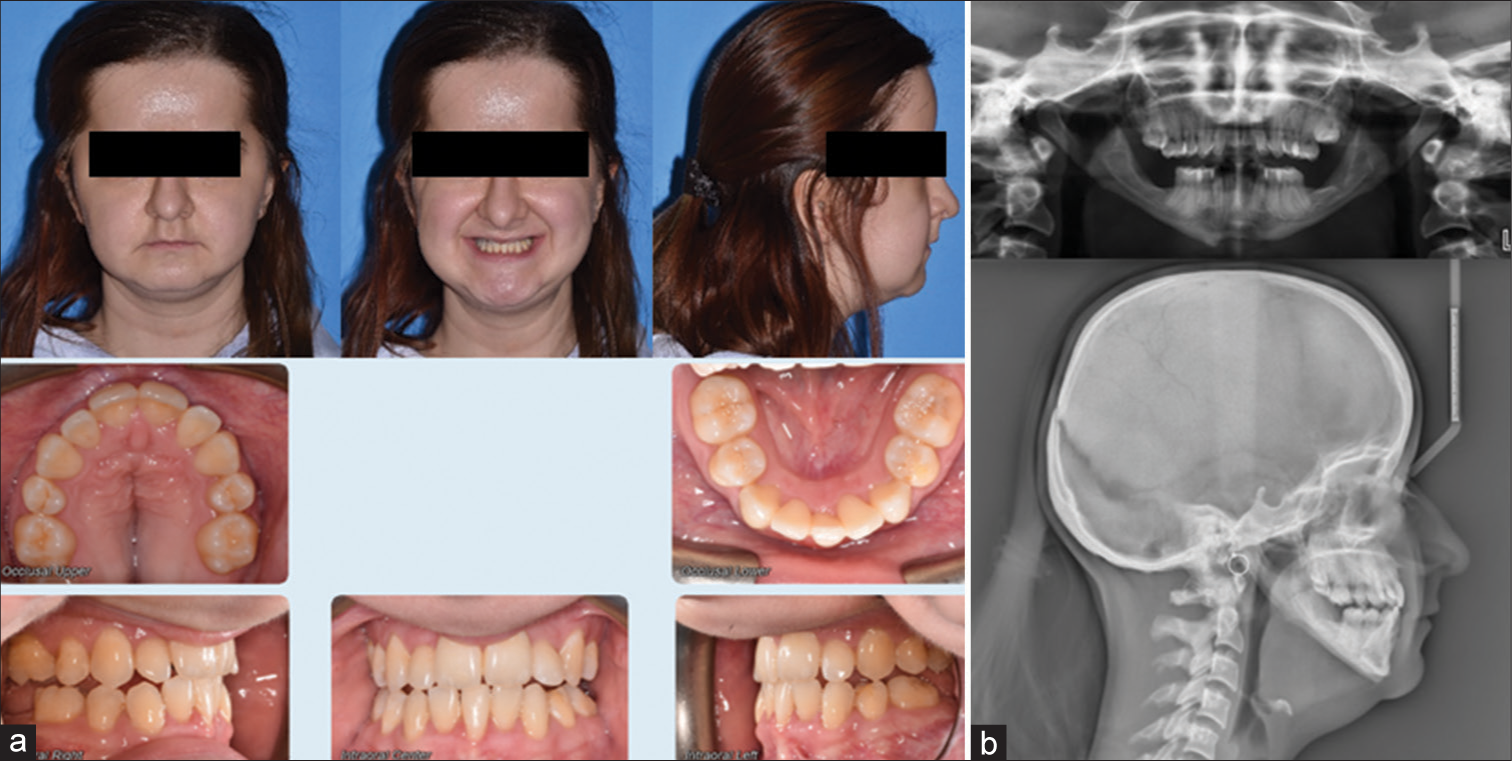 (a) Phase II pre-treatment extraoral and intraoral photographs. (b) Phase II pre-treatment panoramic radiograph and lateral cephalogram.