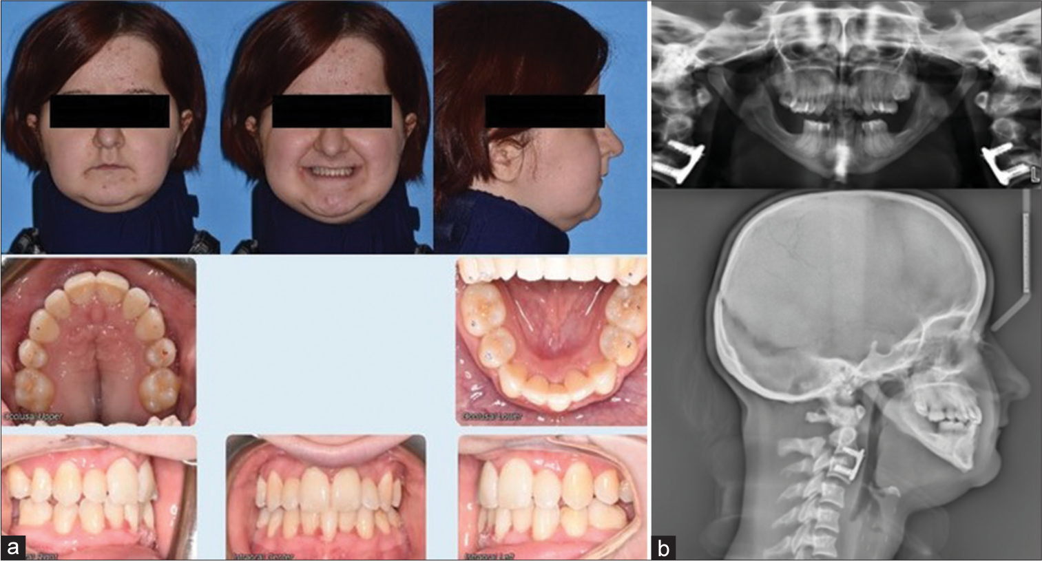 (a) Phase II post-treatment extraoral and intraoral photographs. (b) Phase II post-treatment panoramic radiograph and lateral cephalogram.