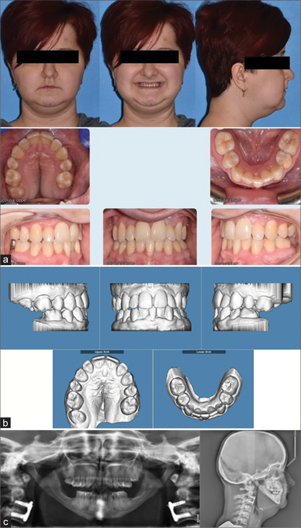 (a) One-year post Phase II treatment extraoral and intraoral photographs. (b) One-year post Phase II treatment models and (c) 1-year post Phase II treatment panoramic radiograph and lateral cephalogram.