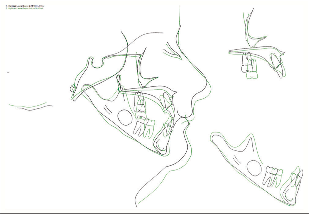 Superimposition of Phase I pre-treatment at age 10 and 1-year-after Phase II post-treatment at age 21 radiographs. Black line: Pre-treatment at age 10; Green line: Post-treatment at age 21.