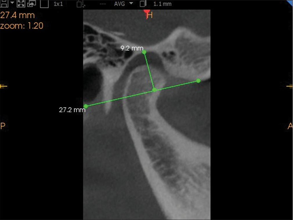 Cone-beam computed tomography image of condyle showing the height of the mandibular fossa in the sagittal plane.