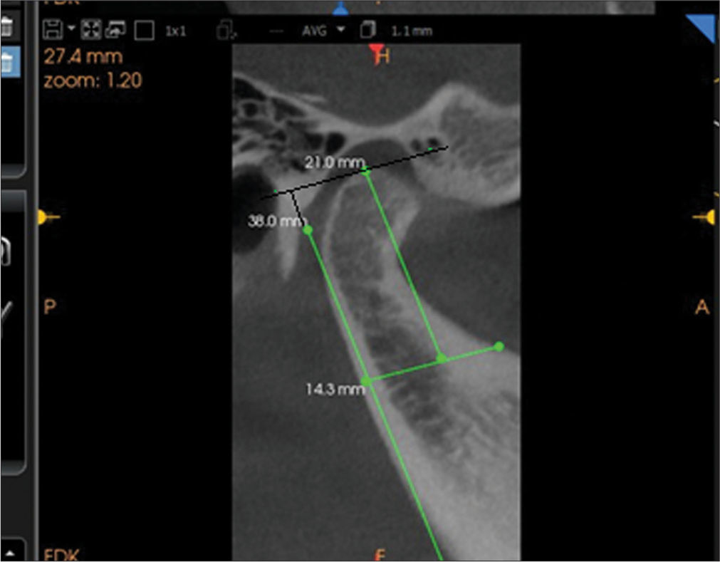 Cone-beam computed tomography image of condyle showing the height of the condyle (The tangent is drawn on the posterior border of the mandible and a perpendicular is drawn from the mandibular notch to this tangent and the perpendicular from the most superior point on the condyle).