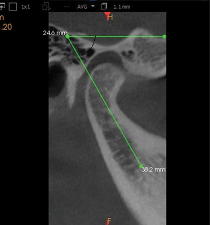 Cone-beam computed tomography image of condyle showing the condylar axis angulation (Angle between the long axis of the condyle and a line parallel to the Frankforts horizontal plane is measured).