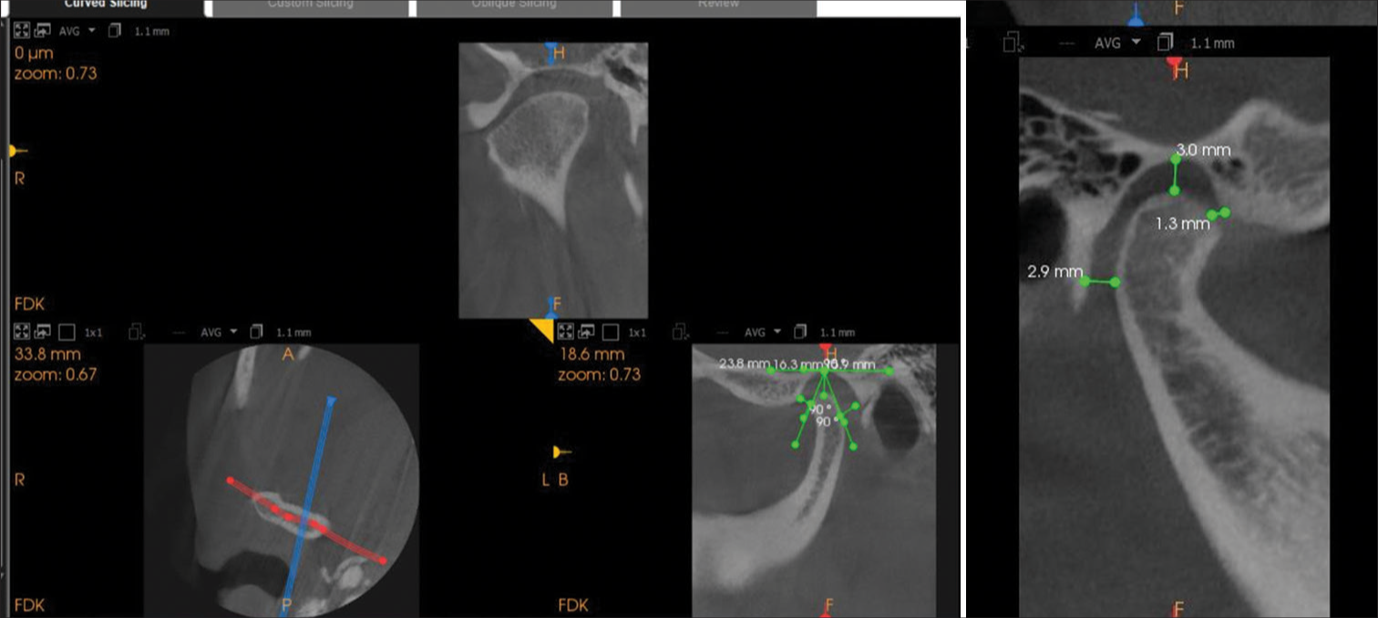 Cone-beam computed tomography image of condyle showing the measurement of the anterior, superior, and posterior joint spaces.