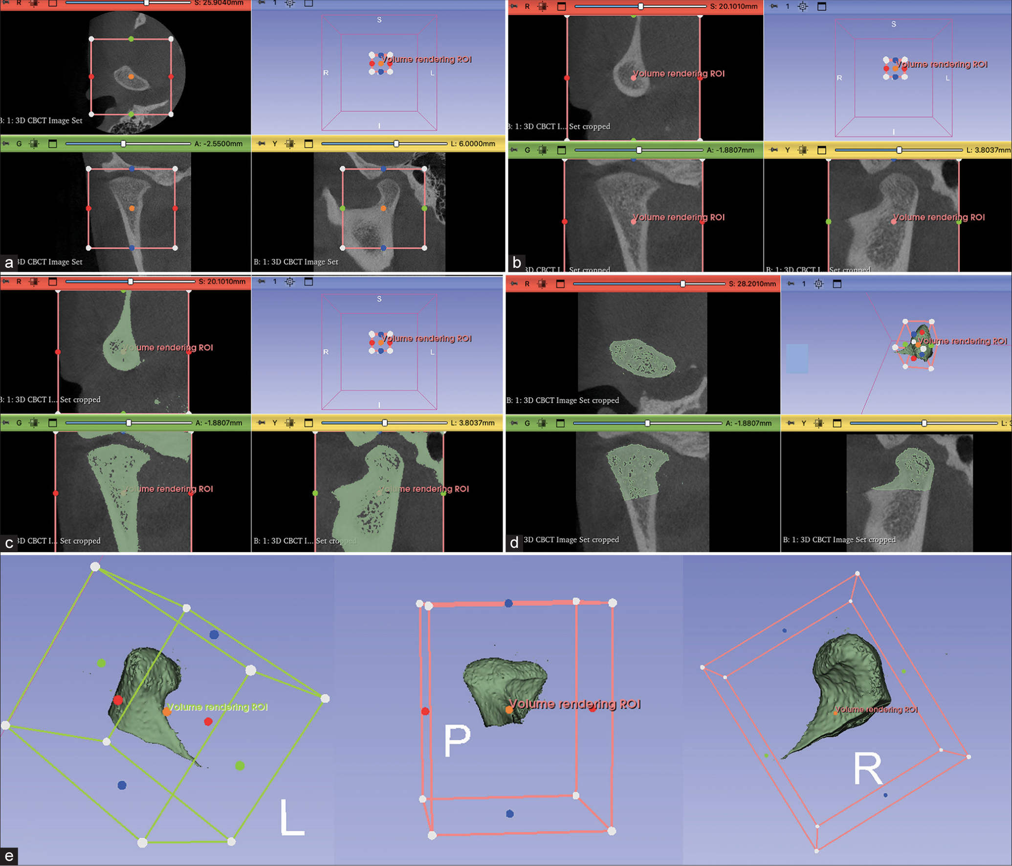 Condylar volume measurement in 3D Slicer. (a) Bounding box showing area of interest. (b) Volume rendered enlarged image showing upper and lower limits. (c) Enlarged condyle is seen within the bone density range. (d) Graphical sculpting tools are used to remove the surrounding structures. (e) 3D reconstructed image of the condyle. ROI: Region of interest, CBCT: Cone-beam computed tomography.