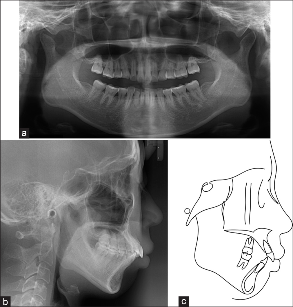 (a) Pretreatment panoramic radiograph, (b) lateral cephalogram, and (c) cephalometric tracing.