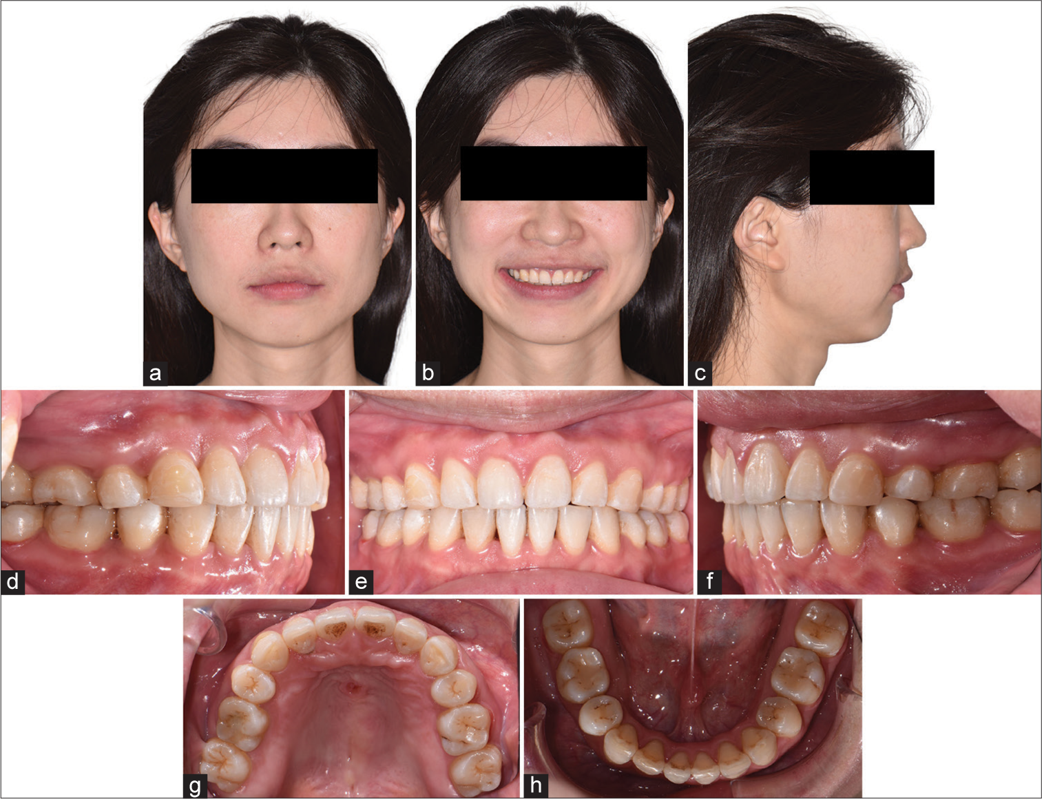 (a-c) Post-treatment facial photos. (d-h) Post-treatment intraoral photos.