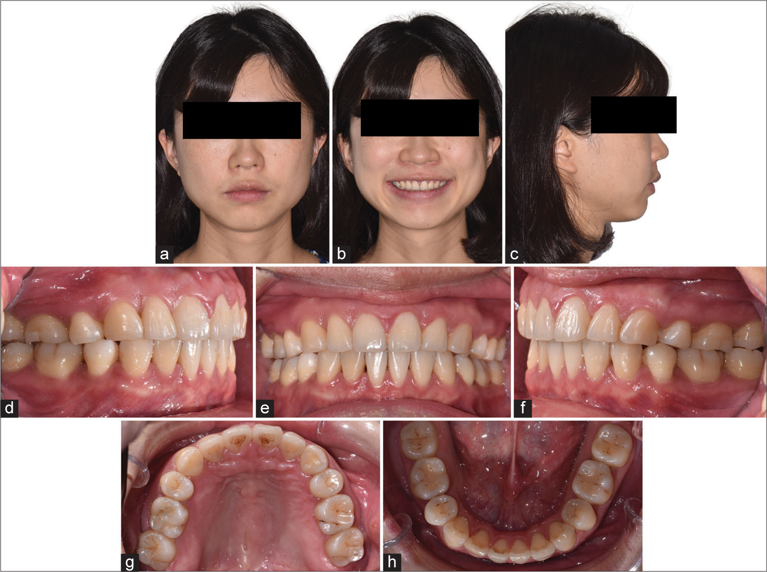 (a-c) Post retention 15 months follow-up facial photos. (d-h) Post retention 15 months follow-up intraoral photos.