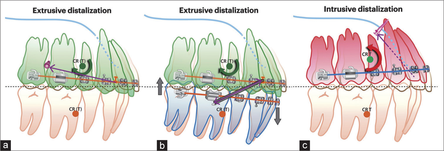 Different vertical effect and occlusal plane change of extrusive and intrusive distalization mechanics: (a) Low-positioned buccal miniscrews: Purple arrow: line of force from short hook on archwire to low-positioned miniscrews, which is below the CR(T). Bold green circular arrow: clockwise rotational moment relative to CR(T), (b) Class II elastics: Purple arrow: line of force provided by class II elastics, which is below the CR(T) Bold green circular arrow: clockwise rotational moment relative to CR(T). The extrusion of maxillary incisors and mandibular molars worsen the gummy smile and induce mandibular backward rotation. (c) High-pull palatal gear technique: Purple dot line: line of force from lateral incisors to midpalatal screw, which is above and in front of the CR(T). Bold red circular arrow: counterclockwise rotational moment relative to CR(T). CR(T): Center of resistance of total dentition.