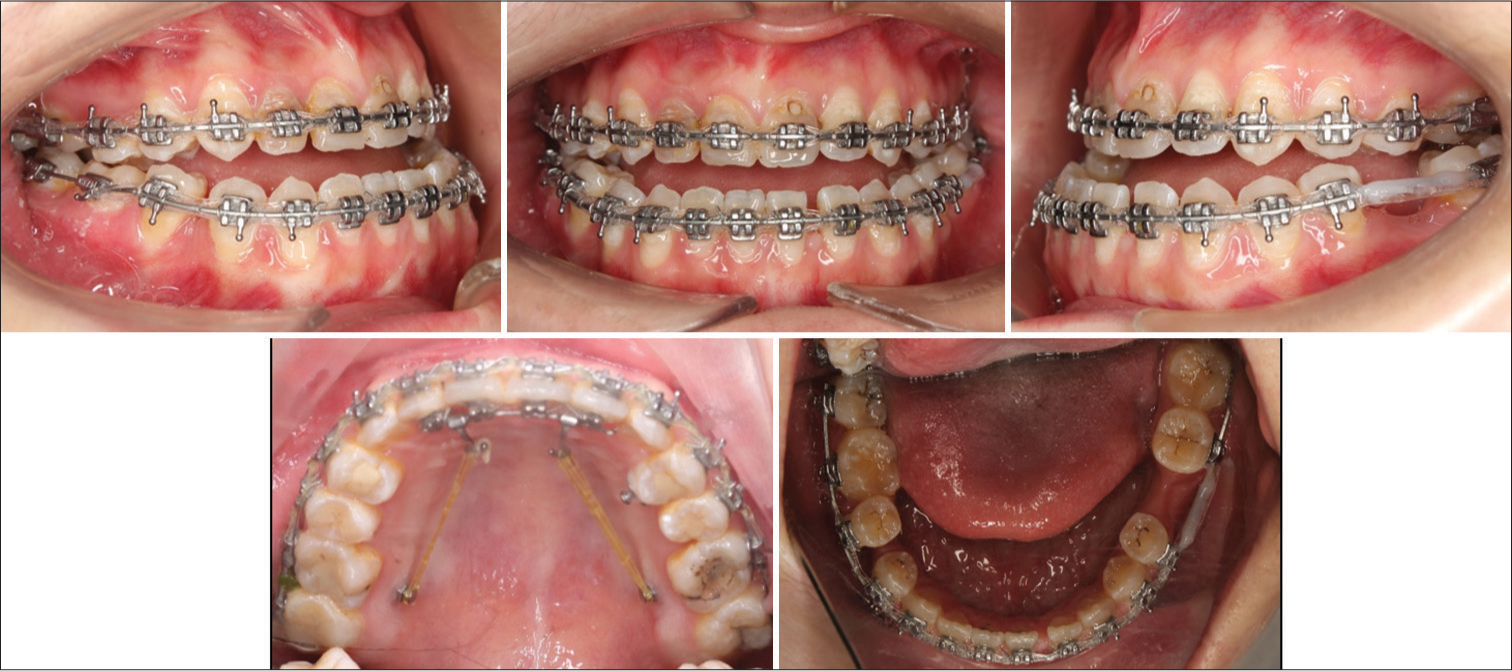 Entire upper arch distalization with mini-screw anchorage to decompensate proclined incisors.