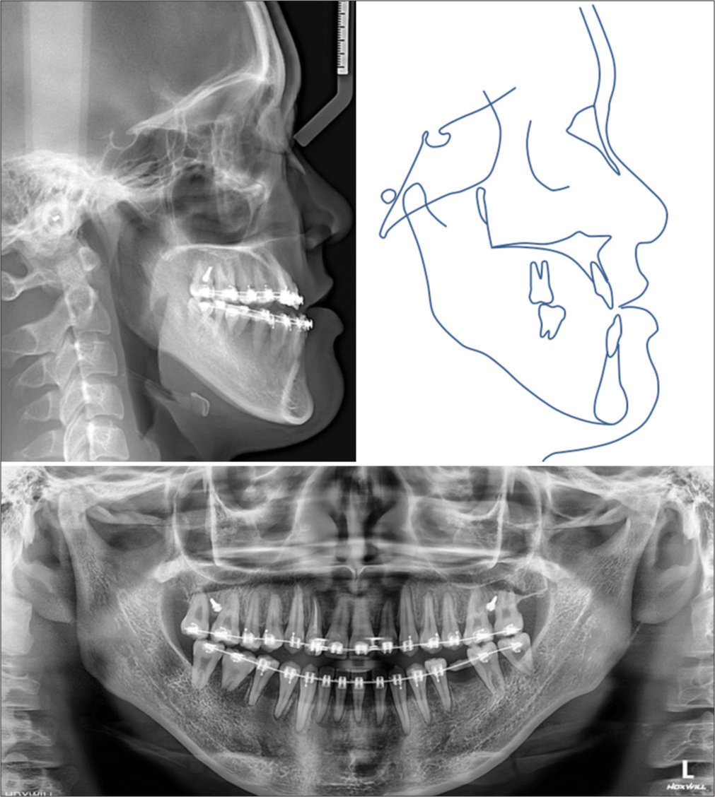 Presurgical radiographs and tracing.